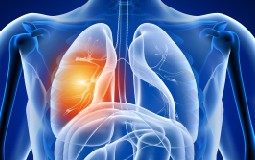 Lung cancer screening
